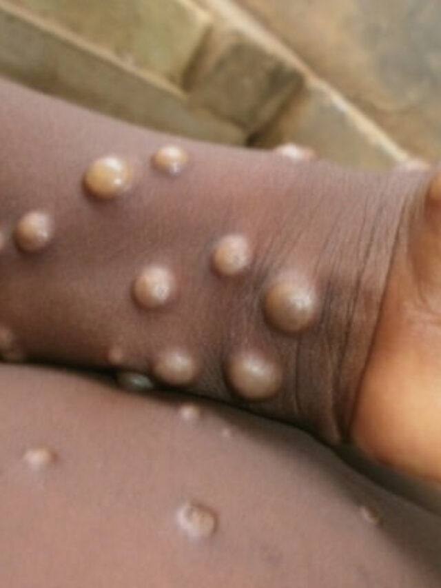 Monkeypox क्या है? क्या SEX से फैलता है!